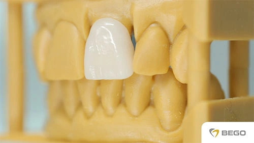 VarseoSmile Crown plus – Post-processing of a 3D Printed Crown