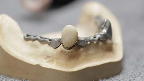 Processing of a 3D-printed veneer shell