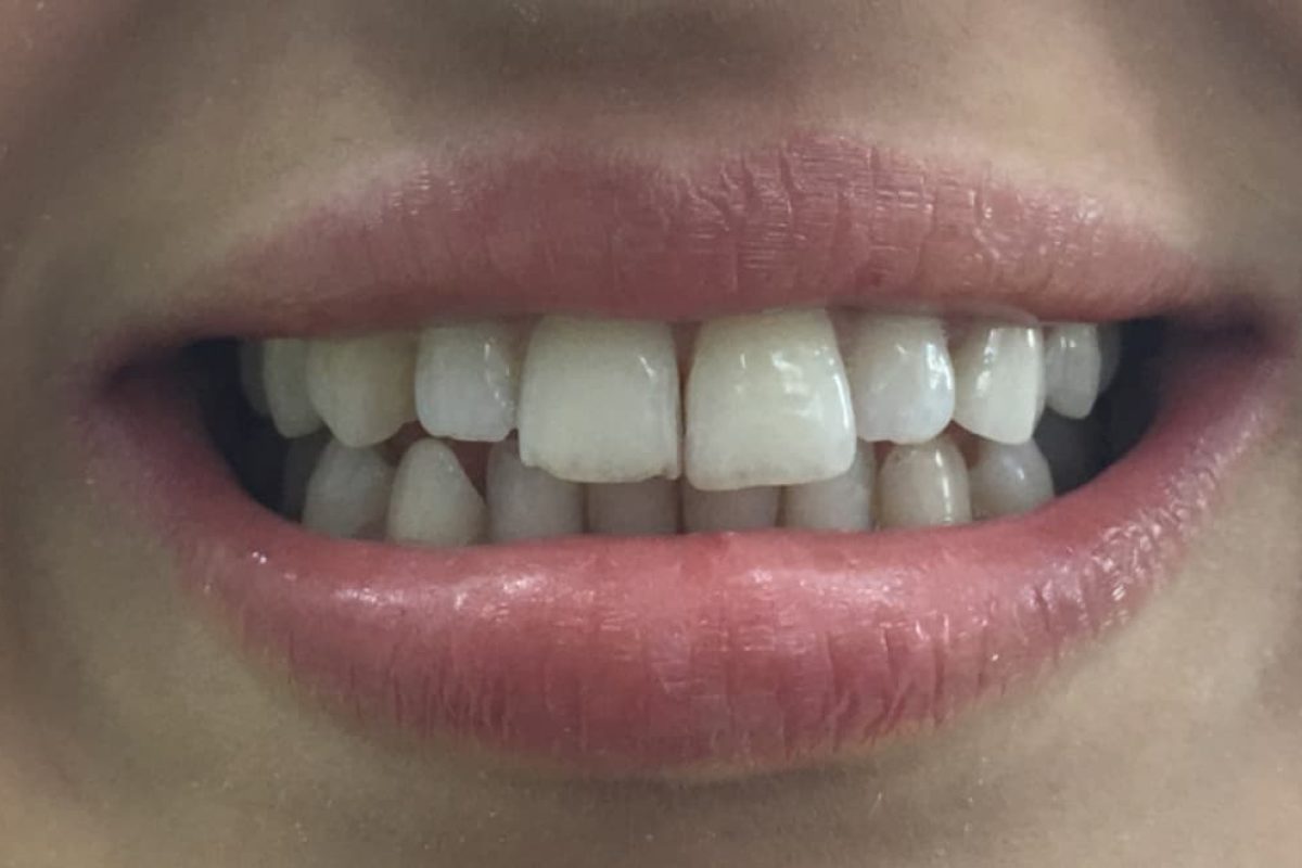 Renklenmiş Maksiller Kanin